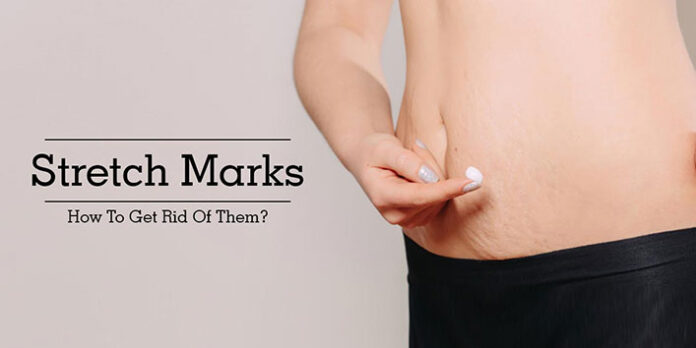 HOW TO GET RID OF STRETCH MARKS