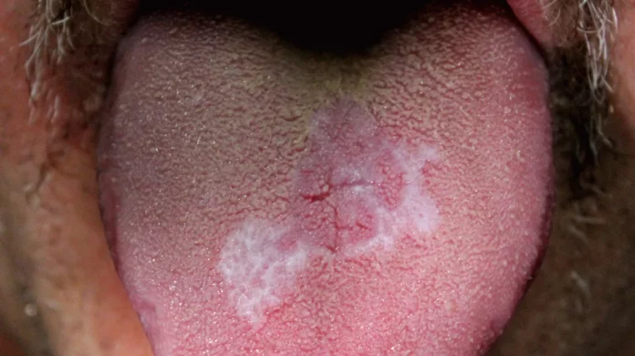 How Do I Get Rid Of The White Stuff On My Tongue