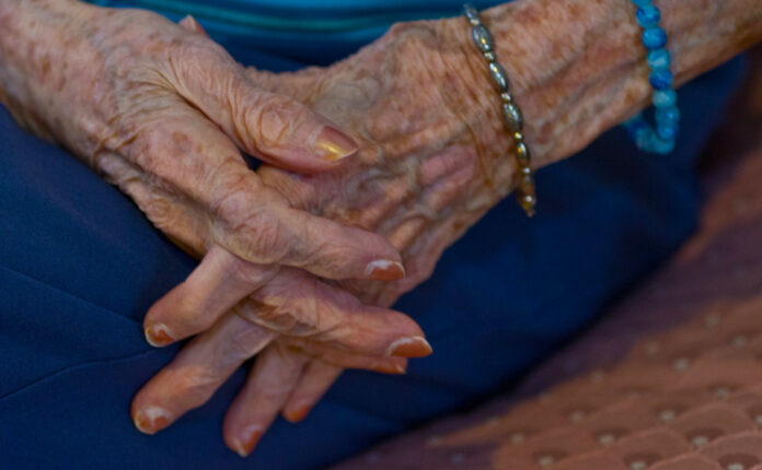 Why do you bruise easily as you age and how to treat it?